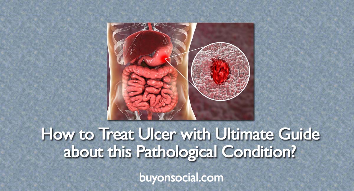 How to Treat Ulcer with Ultimate Guide about this Pathological Condition?