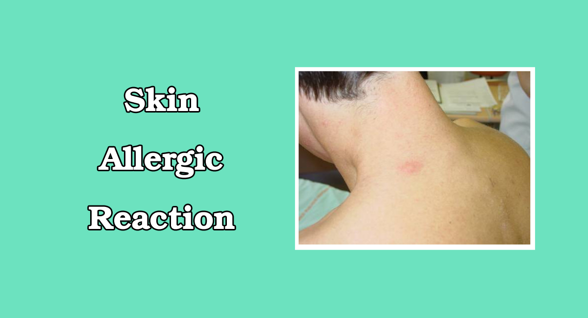 Skin Allergic Reaction: Reasons, Symptoms and best ways to treat Allergy Reaction